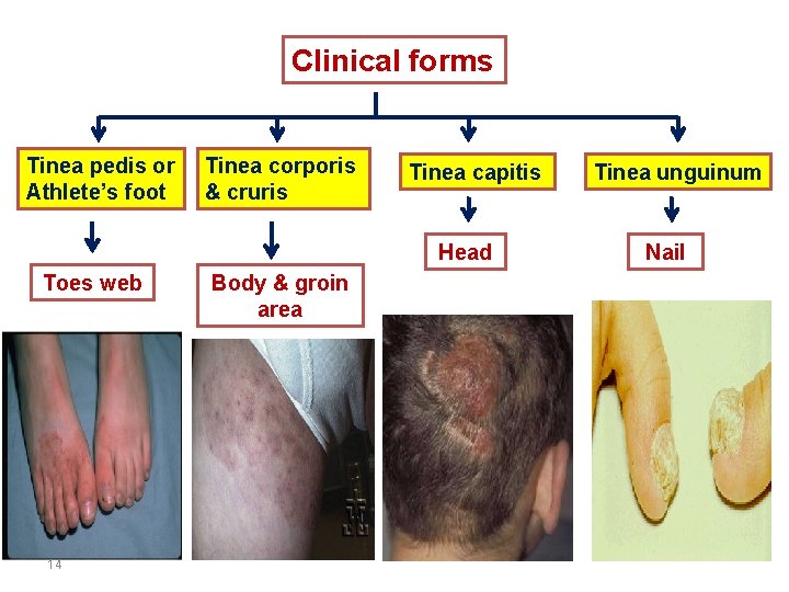 Clinical forms Tinea pedis or Athlete’s foot Tinea corporis & cruris Tinea capitis Head