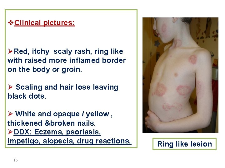 v. Clinical pictures: ØRed, itchy scaly rash, ring like with raised more inflamed border