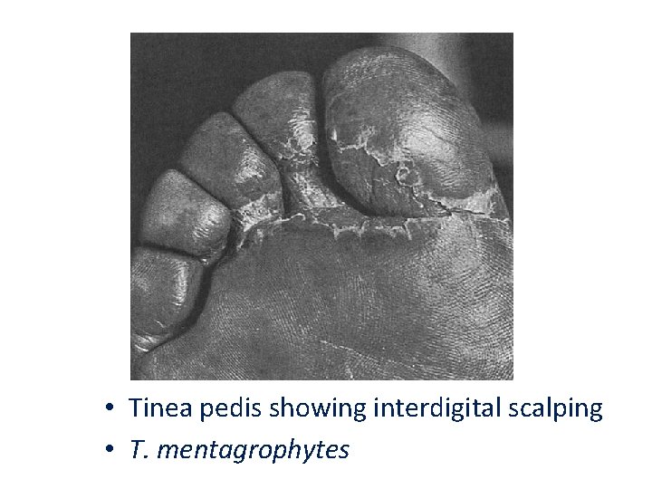  • Tinea pedis showing interdigital scalping • T. mentagrophytes 