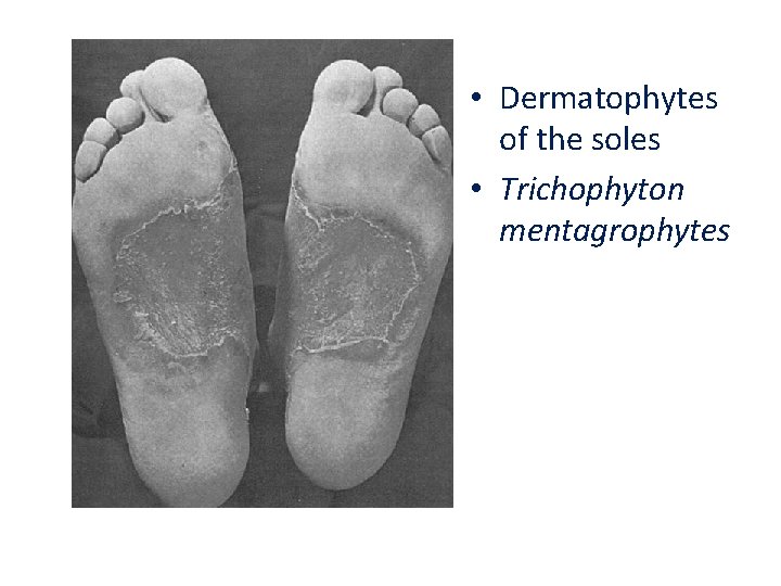  • Dermatophytes of the soles • Trichophyton mentagrophytes 