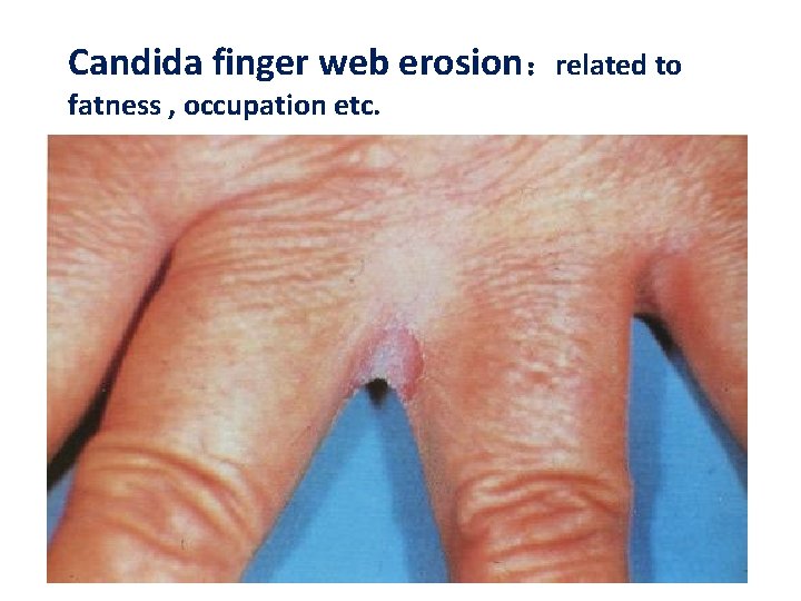 Candida finger web erosion：related to fatness , occupation etc. 