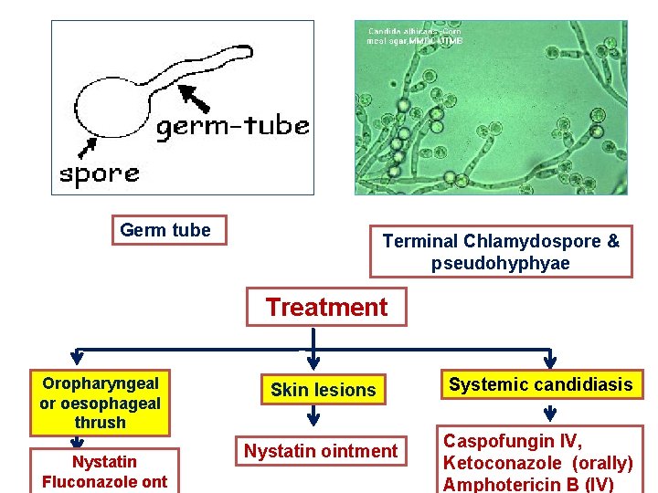 Germ tube Terminal Chlamydospore & pseudohyphyae Treatment Oropharyngeal or oesophageal thrush Nystatin Fluconazole ont