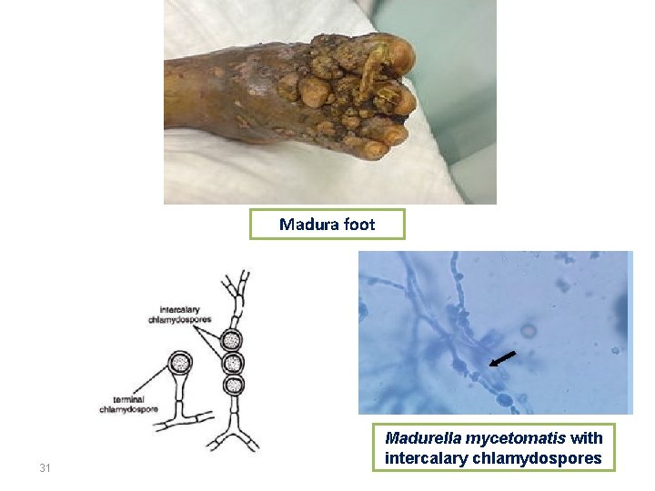 Madura foot 31 Madurella mycetomatis with intercalary chlamydospores 