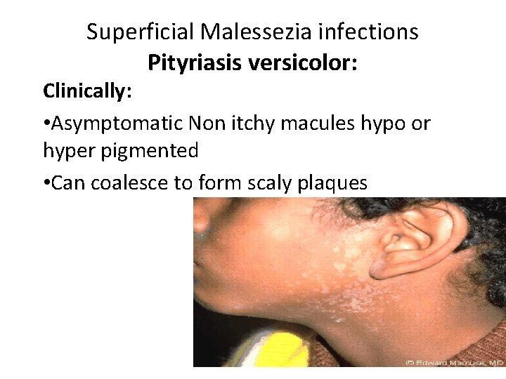 Superficial Malessezia infections Pityriasis versicolor: Clinically: • Asymptomatic Non itchy macules hypo or hyper