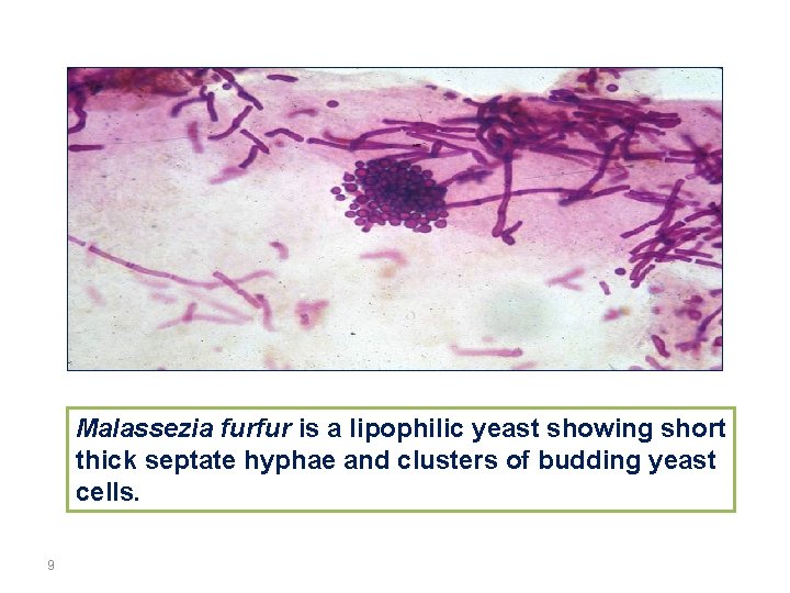 Malassezia furfur is a lipophilic yeast showing short thick septate hyphae and clusters of