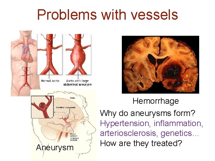 Problems with vessels Aneurysm Hemorrhage Why do aneurysms form? Hypertension, inflammation, arteriosclerosis, genetics… How