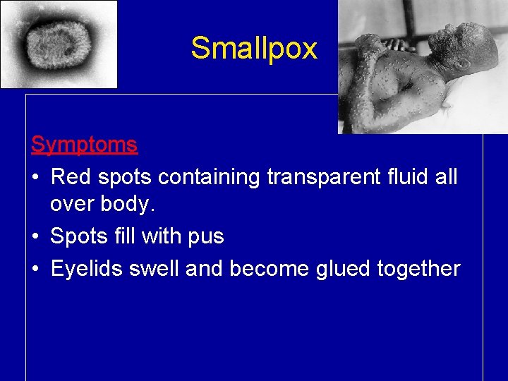 Smallpox Symptoms • Red spots containing transparent fluid all over body. • Spots fill