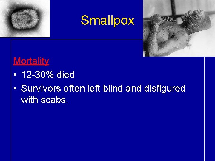 Smallpox Mortality • 12 -30% died • Survivors often left blind and disfigured with