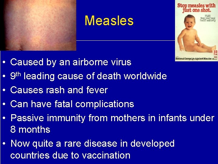 Measles • • • Caused by an airborne virus 9 th leading cause of