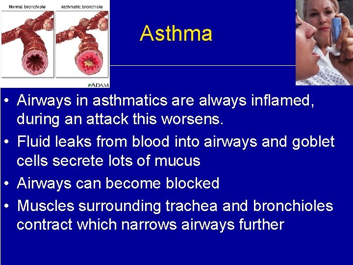 Asthma • Airways in asthmatics are always inflamed, during an attack this worsens. •