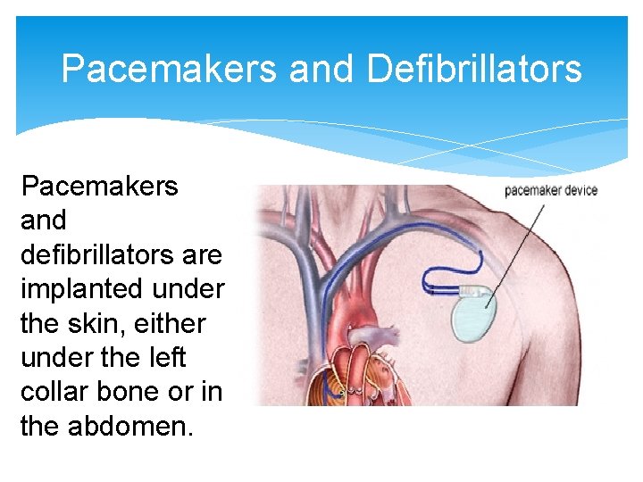 Pacemakers and Defibrillators Pacemakers and defibrillators are implanted under the skin, either under the