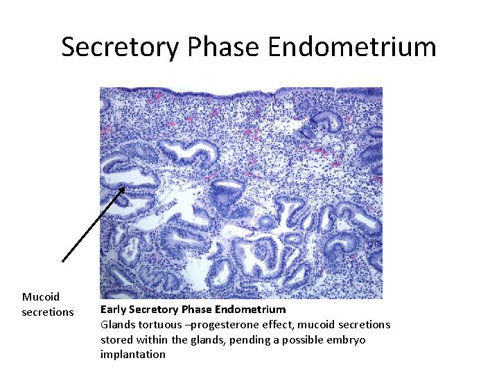 Secretory Phase Endometrium Mucoid secretions Early Secretory Phase Endometrium Glands tortuous –progesterone effect, mucoid
