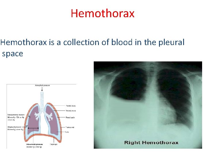 Hemothorax is a collection of blood in the pleural space 