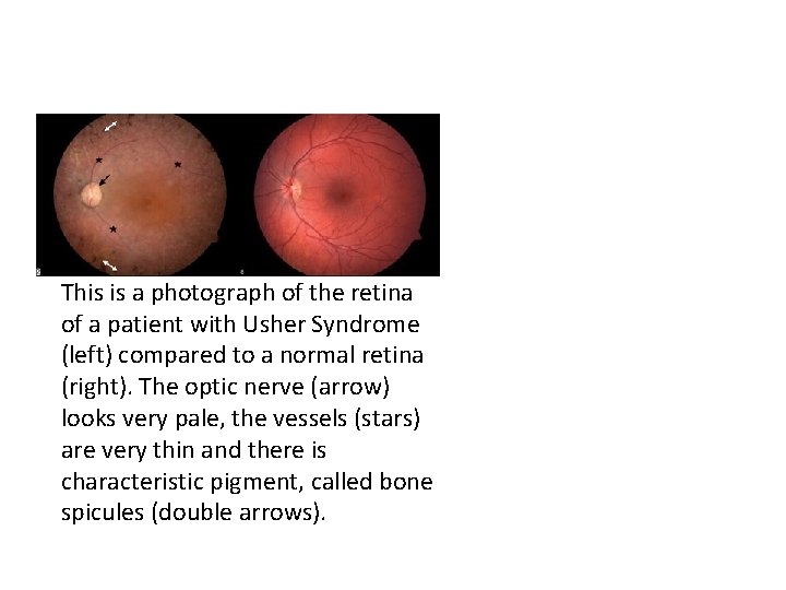 This is a photograph of the retina of a patient with Usher Syndrome (left) This is a photograph of the retina of a patient with Usher Syndrome (left)