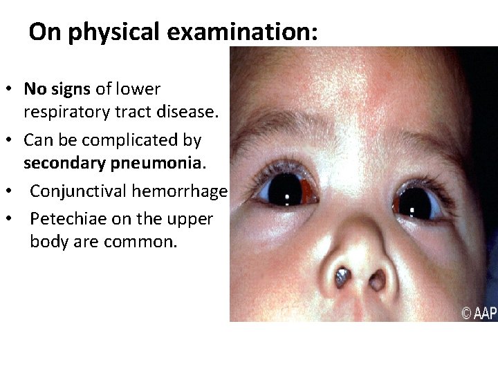 On physical examination: • No signs of lower respiratory tract disease. • Can be