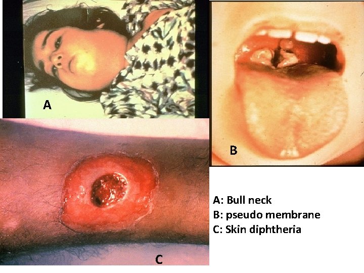 A B A: Bull neck B: pseudo membrane C: Skin diphtheria C 