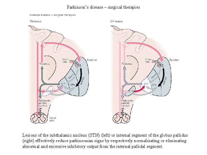 Parkinson’s disease – surgical therapies Lesions of the subthalamic nucleus (STN) (left) or internal