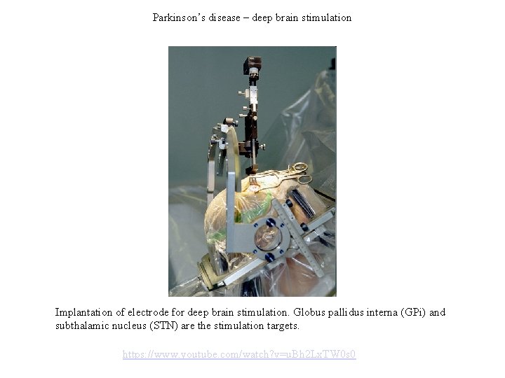 Parkinson’s disease – deep brain stimulation Implantation of electrode for deep brain stimulation. Globus