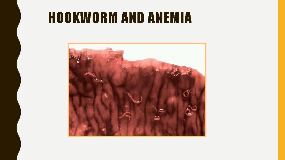 HOOKWORM AND ANEMIA 