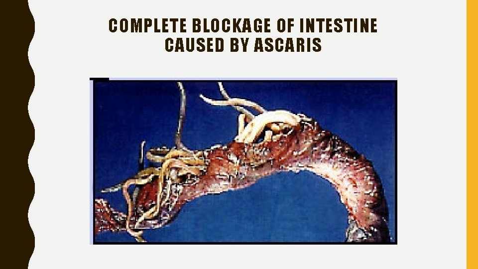 COMPLETE BLOCKAGE OF INTESTINE CAUSED BY ASCARIS 