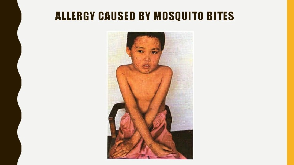 ALLERGY CAUSED BY MOSQUITO BITES 