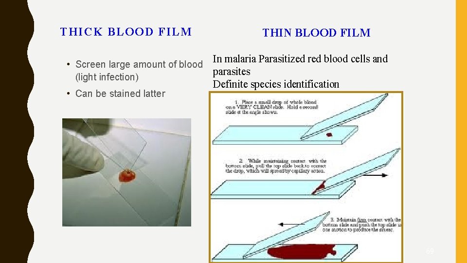 THICK BLOOD FILM • Screen large amount of blood (light infection) • Can be