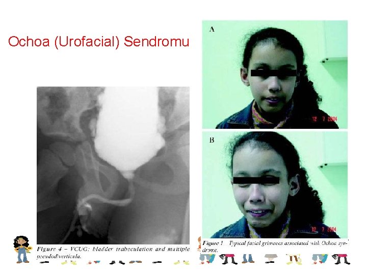 Ochoa (Urofacial) Sendromu 