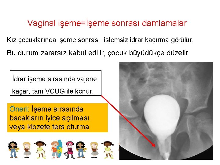 Vaginal işeme=İşeme sonrası damlamalar Kız çocuklarında işeme sonrası istemsiz idrar kaçırma görülür. Bu durum