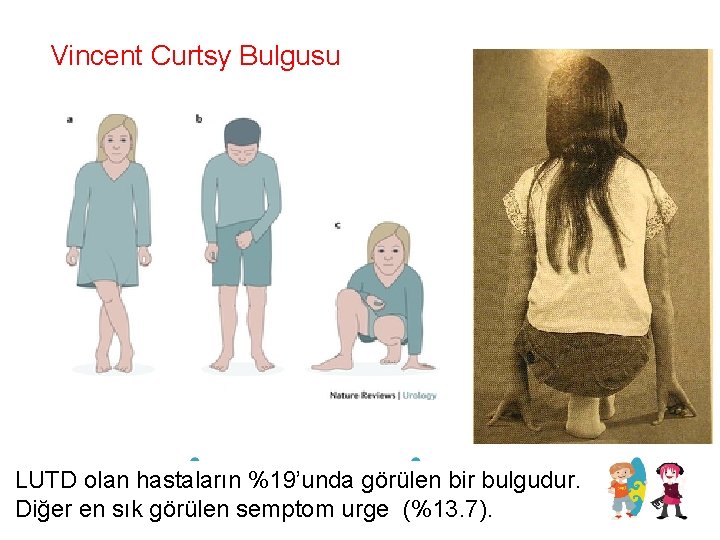 Vincent Curtsy Bulgusu LUTD olan hastaların %19’unda görülen bir bulgudur. Diğer en sık görülen