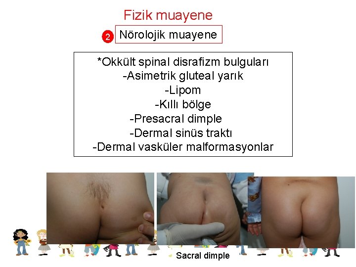 Fizik muayene 2 Nörolojik muayene *Okkült spinal disrafizm bulguları -Asimetrik gluteal yarık -Lipom -Kıllı