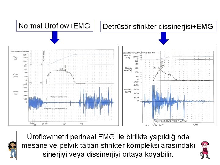 Normal Uroflow+EMG Detrüsör sfinkter dissinerjisi+EMG Üroflowmetri perineal EMG ile birlikte yapıldığında mesane ve pelvik