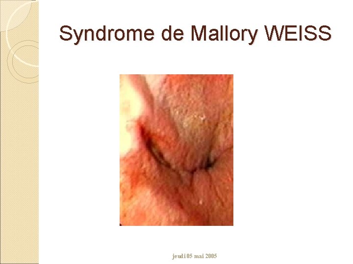 Syndrome de Mallory WEISS jeudi 05 mai 2005 