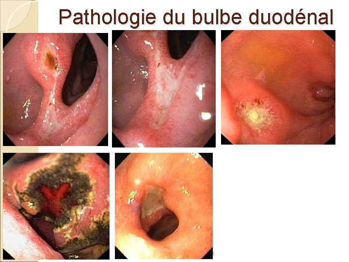 Pathologie du bulbe duodénal jeudi 05 mai 2005 