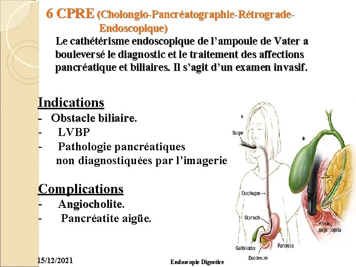 6 CPRE (Cholongio-Pancréatographie-Rétrograde. Endoscopique) Le cathétérisme endoscopique de l’ampoule de Vater a bouleversé le
