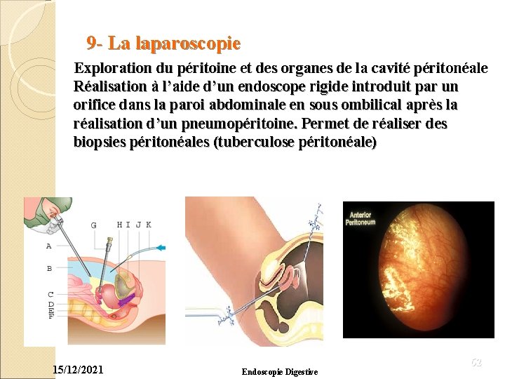 9 - La laparoscopie Exploration du péritoine et des organes de la cavité péritonéale