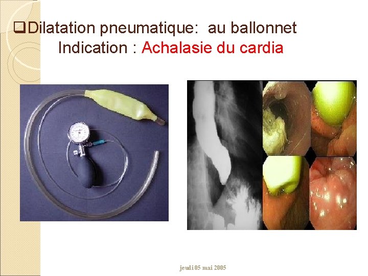 q. Dilatation pneumatique: au ballonnet Indication : Achalasie du cardia jeudi 05 mai 2005