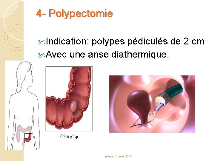 4 - Polypectomie Indication: polypes pédiculés de 2 cm Avec une anse diathermique. jeudi