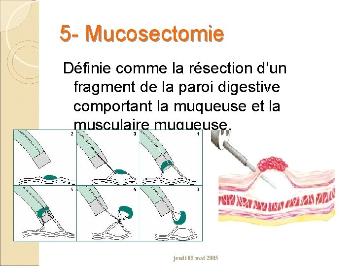 5 - Mucosectomie Définie comme la résection d’un fragment de la paroi digestive comportant
