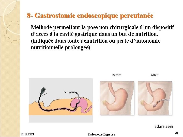 8 - Gastrostomie endoscopique percutanée Méthode permettant la pose non chirurgicale d’un dispositif d’accès