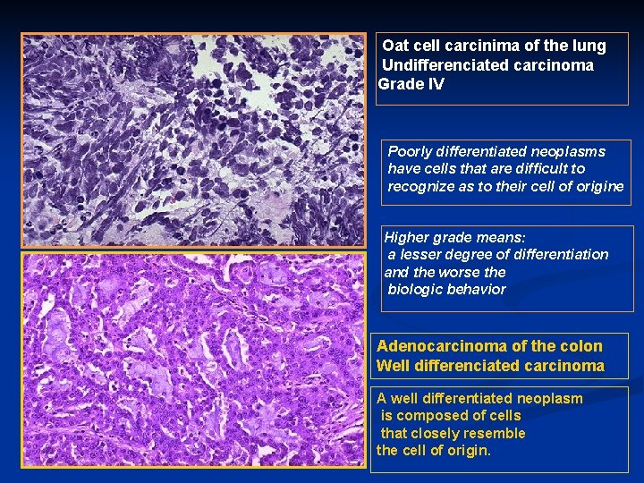 Oat cell carcinima of the lung Undifferenciated carcinoma Grade IV Poorly differentiated neoplasms have