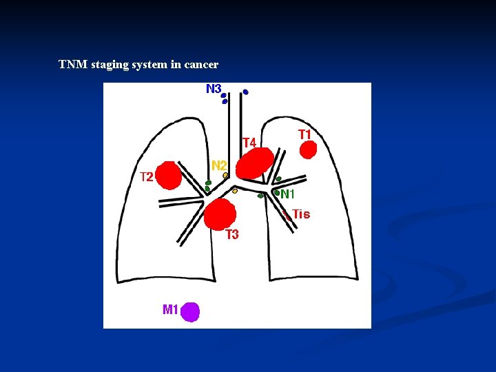 TNM staging system in cancer 