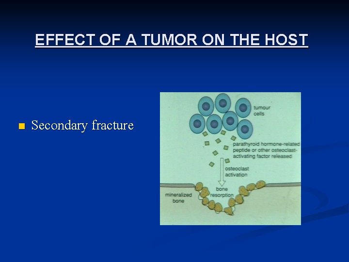 EFFECT OF A TUMOR ON THE HOST n Secondary fracture 