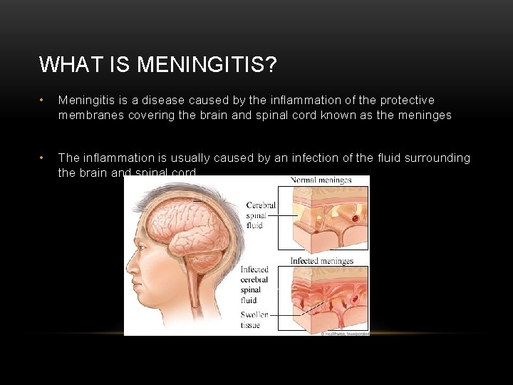WHAT IS MENINGITIS? • Meningitis is a disease caused by the inflammation of the