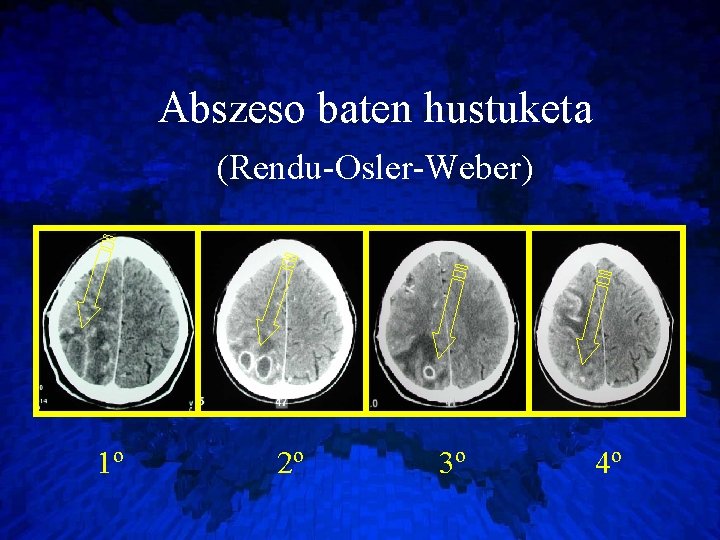 Abszeso baten hustuketa (Rendu-Osler-Weber) 1º 2º 3º 4º 