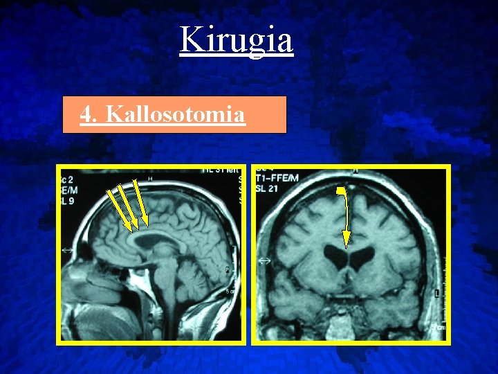 Kirugia 4. Kallosotomia 