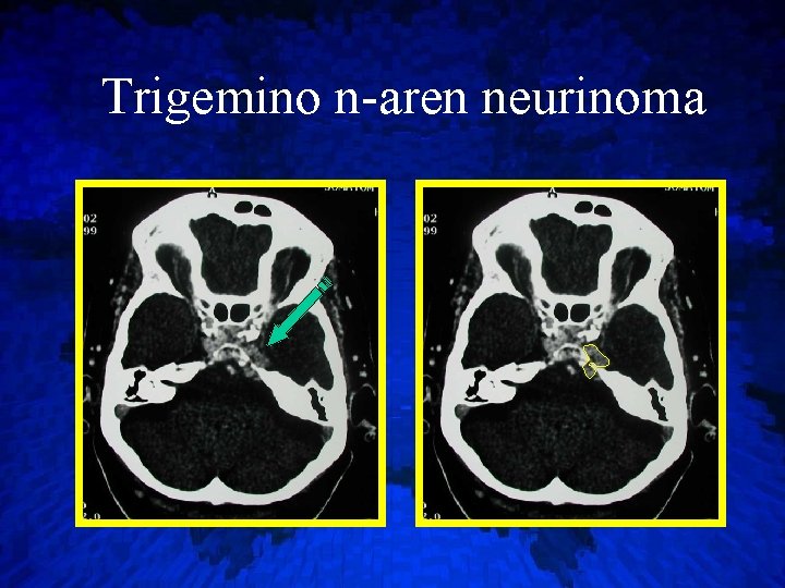 Trigemino n-aren neurinoma 