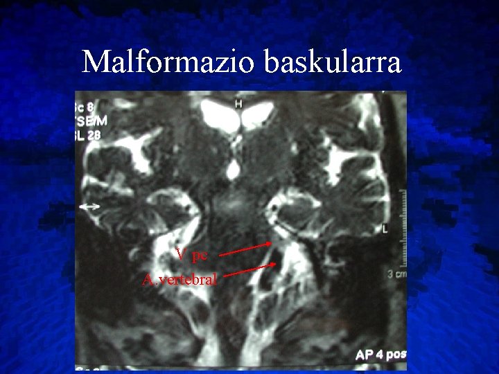 Malformazio baskularra V pc A. vertebral 