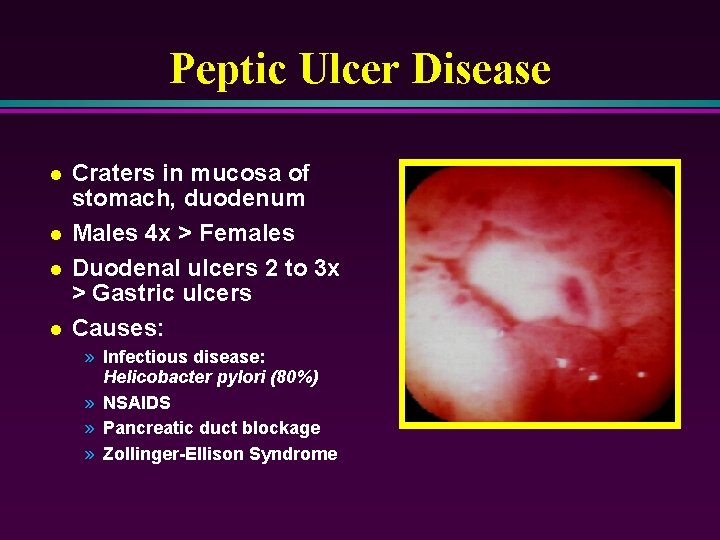 Peptic Ulcer Disease l l Craters in mucosa of stomach, duodenum Males 4 x