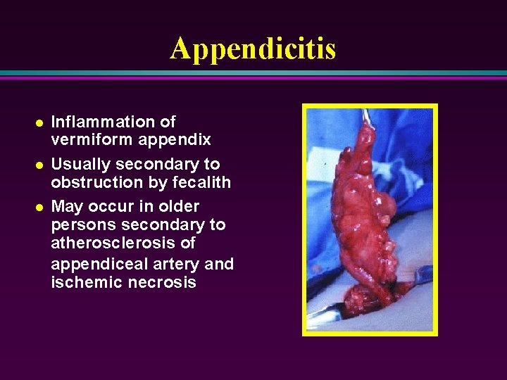 Appendicitis l l l Inflammation of vermiform appendix Usually secondary to obstruction by fecalith