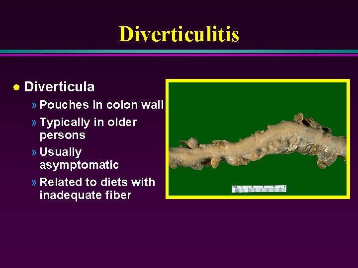 Diverticulitis l Diverticula » Pouches in colon wall » Typically in older persons »